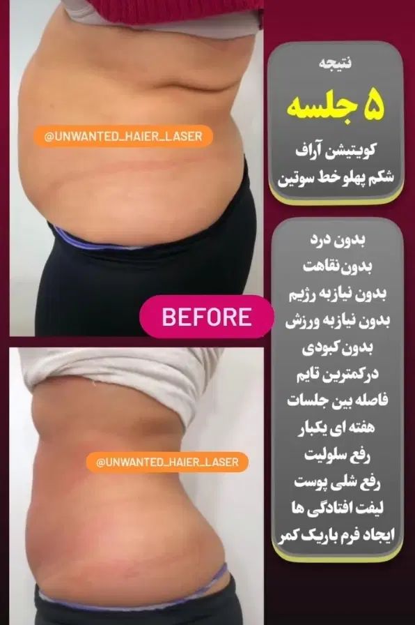 لیزرموهای زائدولیزرلاغری وسم زدایی خال برداری|خدمات آرایشگری و زیبایی|کرمانشاه, |دیوار