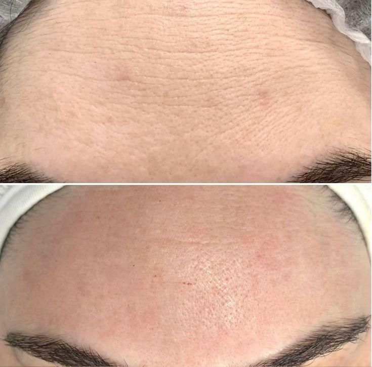 جشنواره اقساطی لیفت صورت|خدمات آرایشگری و زیبایی|تهران, نیلوفر|دیوار