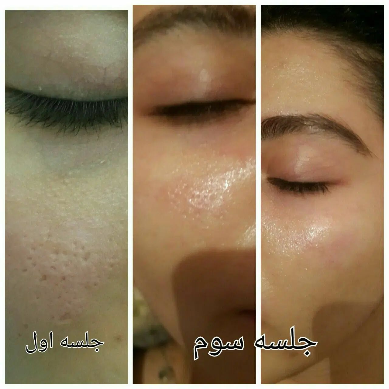 جشنواره تخفیف ویژه تابستانی  پاکسازی تخصص پوست|خدمات آرایشگری و زیبایی|نوشهر, |دیوار