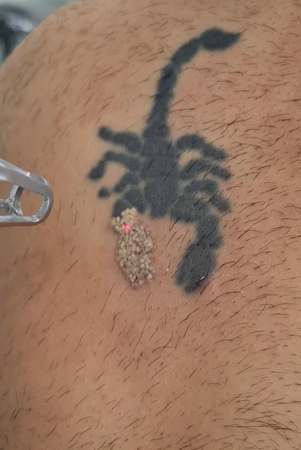 پاک کردن تاتو بدون درد با دستگاه کیوسوئیچ پیکوسکند|خدمات آرایشگری و زیبایی|ساری, |دیوار