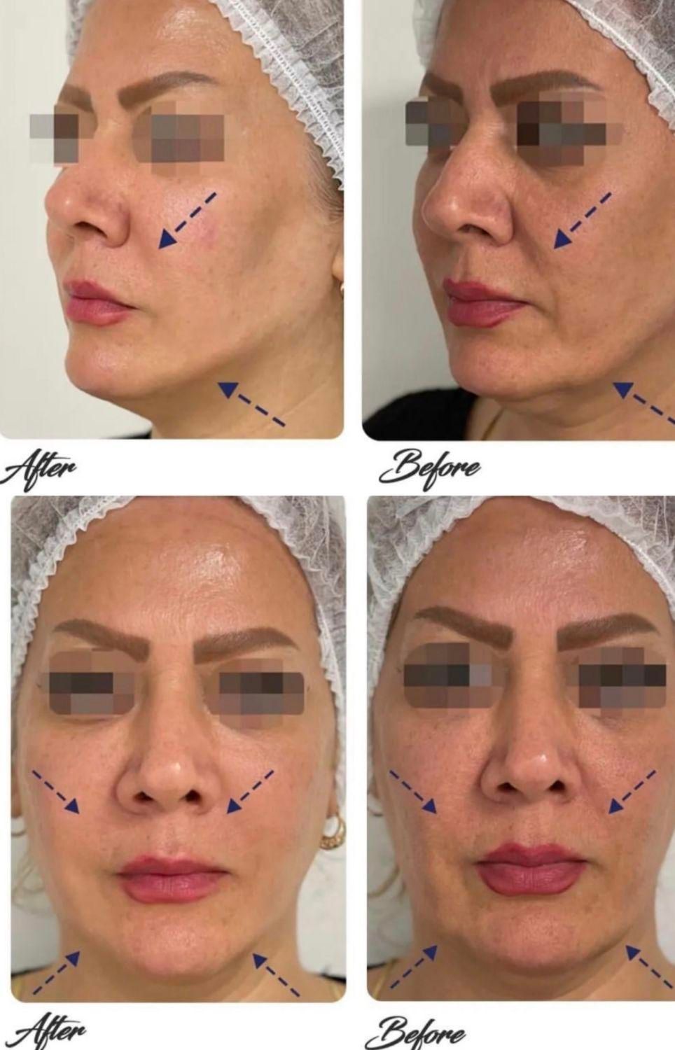 جشنواره هایفوتراپی vip همراه فیشال اشانتیون|خدمات آرایشگری و زیبایی|رشت, رودباری|دیوار