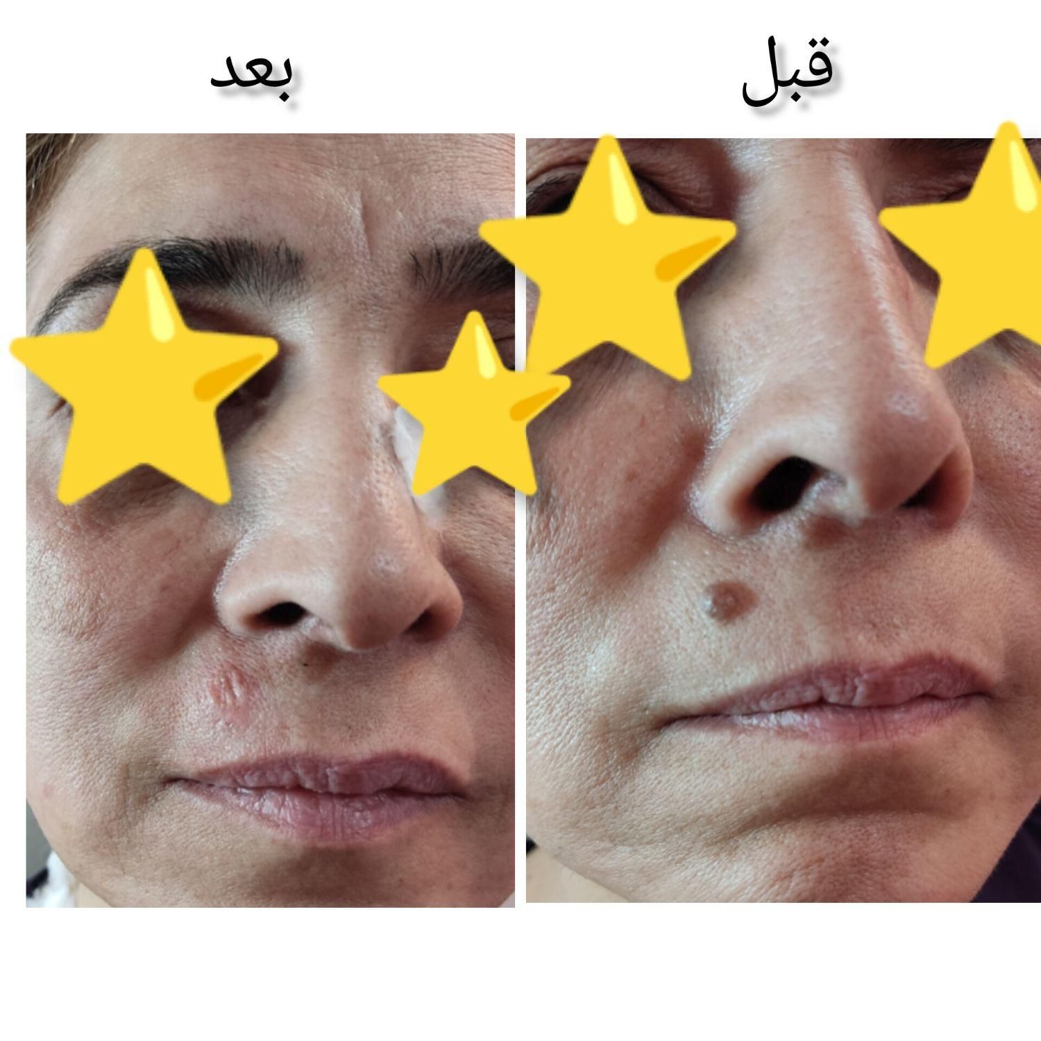 لیزر موهای زائدسوپرانو تیتانیوم وخالبرداری|خدمات آرایشگری و زیبایی|صدرا-فارس, فاز ۱|دیوار