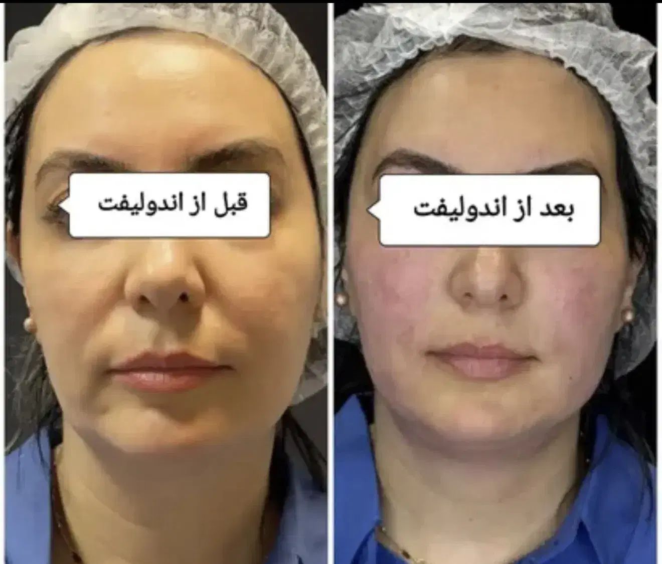 پکیج اقتصادی جوانسازی و لیفت اندوهایفو دکتر داریوش|خدمات آرایشگری و زیبایی|مشهد, راهنمایی|دیوار
