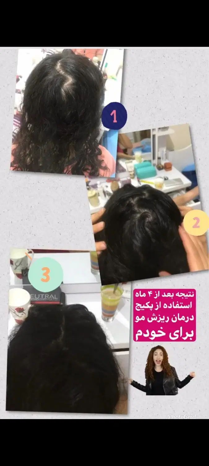 درمان ریزش مو خودتان را به ما بسپار|آرایشی، بهداشتی، درمانی|رشت, خواهر امام|دیوار