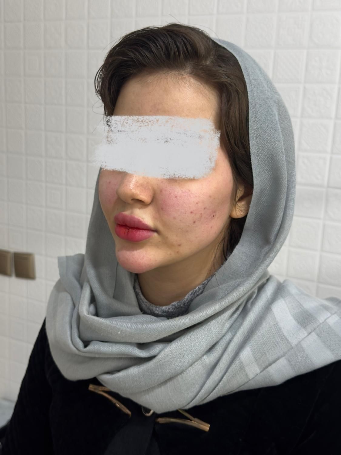 جشنواره لابیاپلاستی تزریق چربی تزریق فیلربادی غبغب|خدمات آرایشگری و زیبایی|تهران, عبدل‌آباد|دیوار