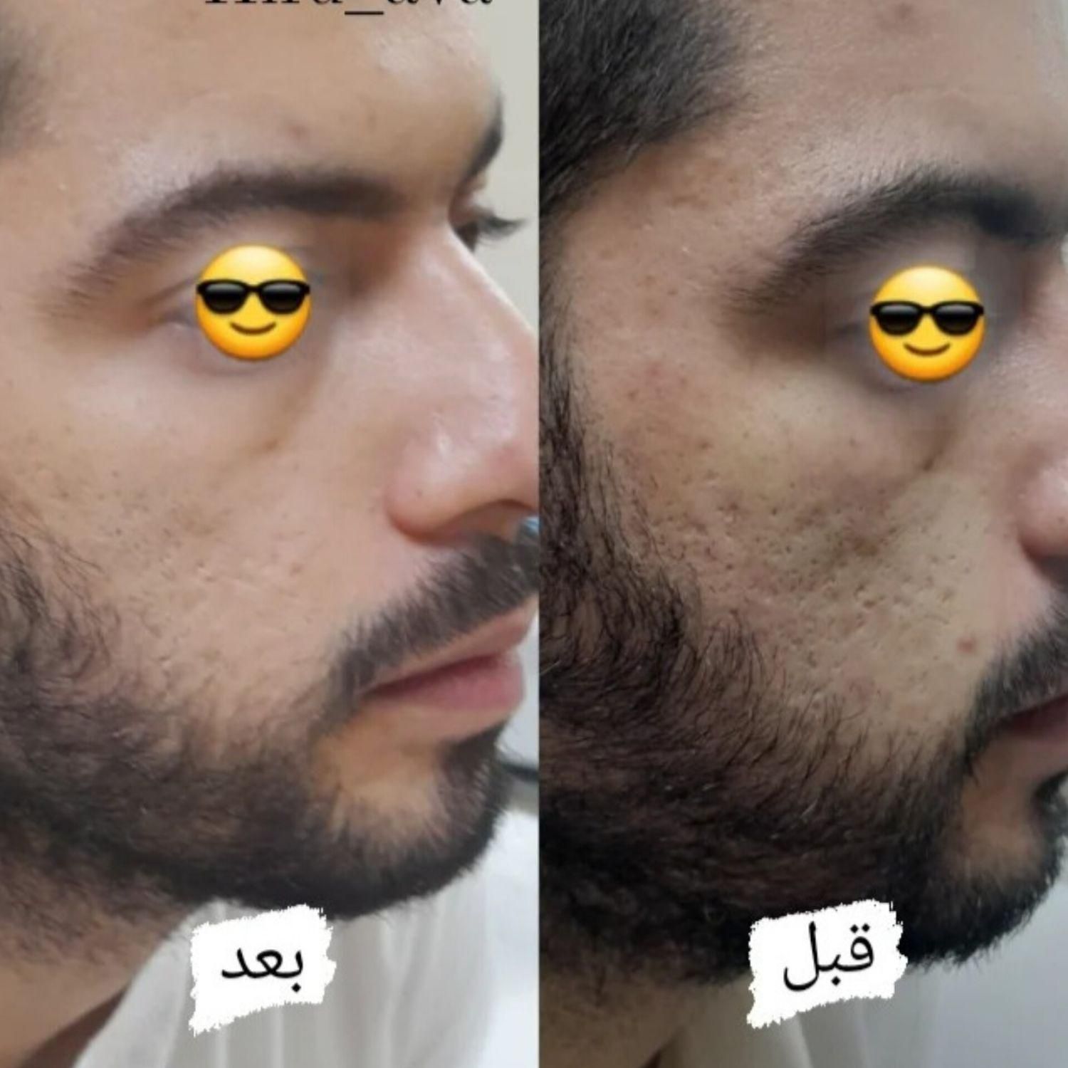 لیزر موهای زائد صورت وبدن،  جوانسازی پوست|خدمات آرایشگری و زیبایی|رفسنجان, |دیوار