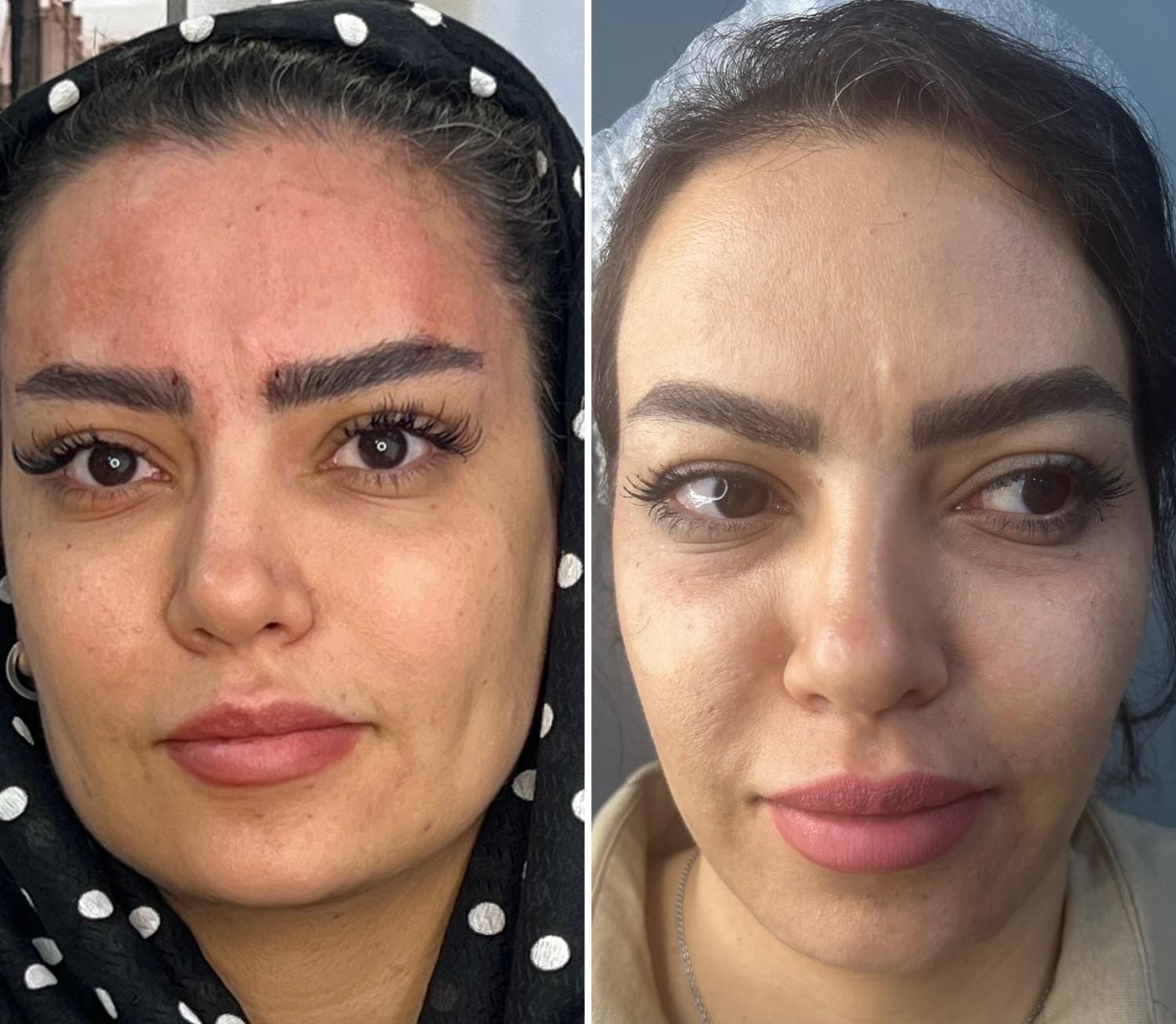 لیفت تخصصی صورت و ابرو فقط امرور با ۴۰ درصد تخفیف|خدمات آرایشگری و زیبایی|شیراز, بعثت|دیوار