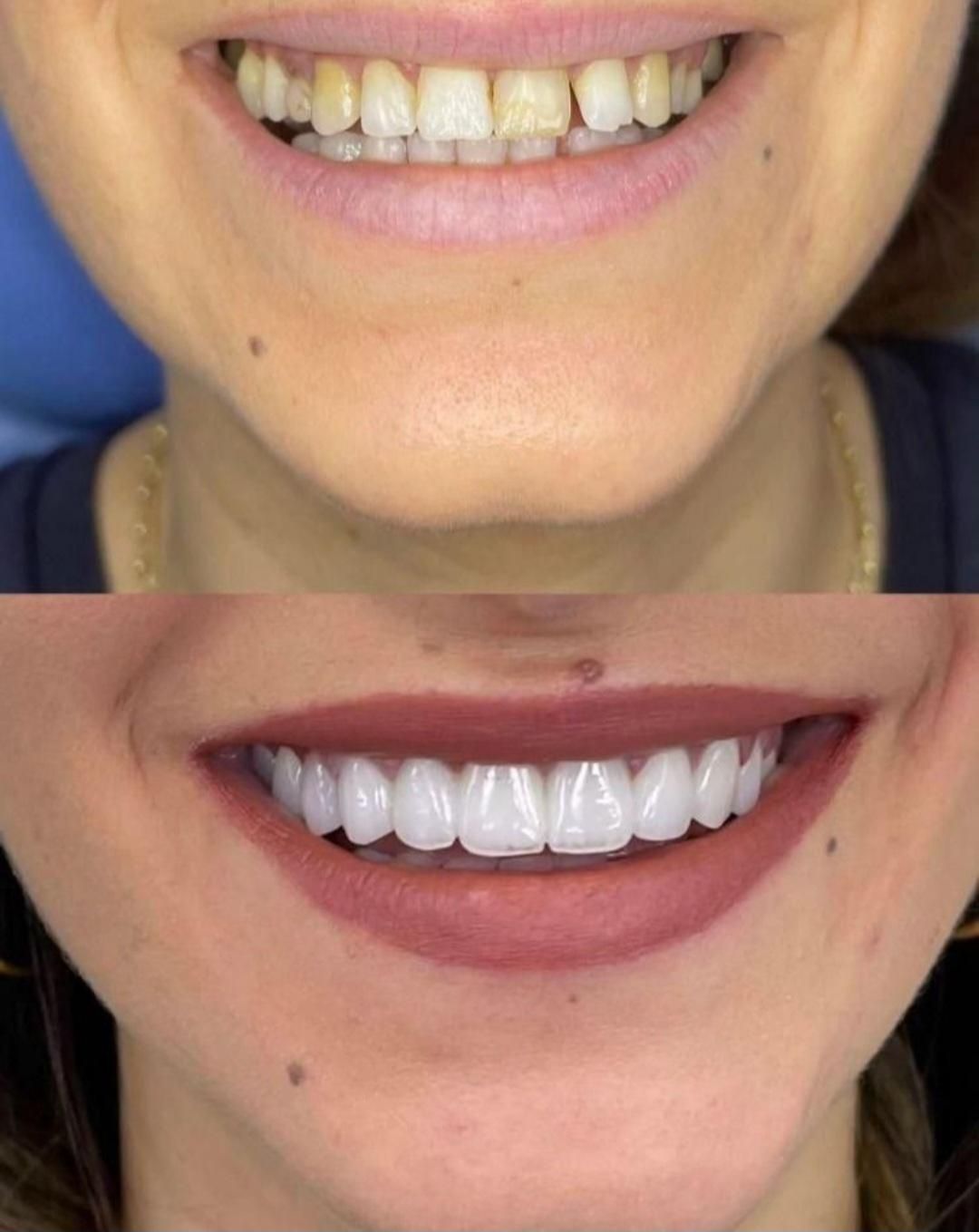 کامپوزیت. لمینت .عصب کشی .مروارید|خدمات آرایشگری و زیبایی|مشکین‌دشت, |دیوار