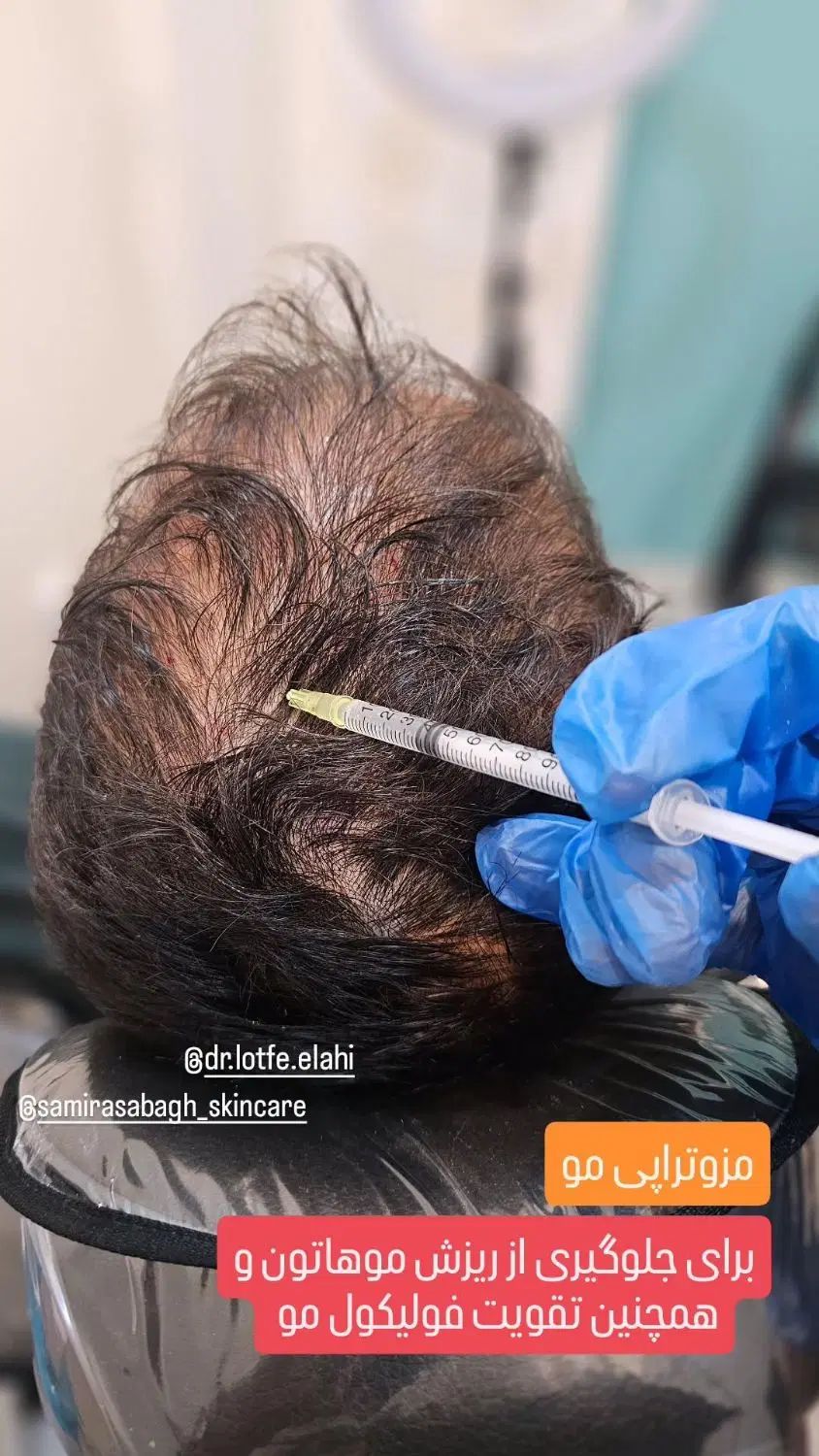 مزوتراپی مو ، ابرو ، جوانسازی ، فیشیال ، پاکسازی|خدمات آرایشگری و زیبایی|کرج, جهان‌شهر|دیوار