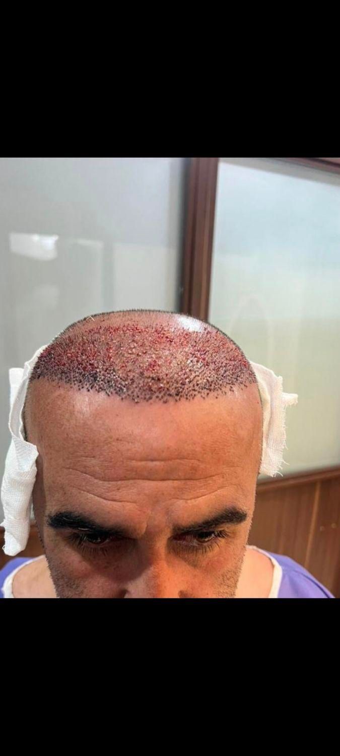 کاشت مو|خدمات آرایشگری و زیبایی|ایلام, |دیوار