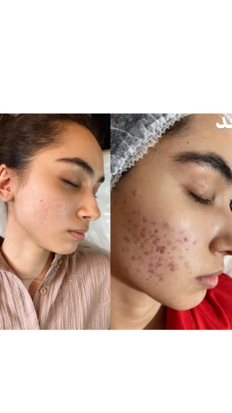 فشیال پاکسازی لیزر پوست جوانساز|خدمات آرایشگری و زیبایی|شیراز, معالی‌آباد|دیوار