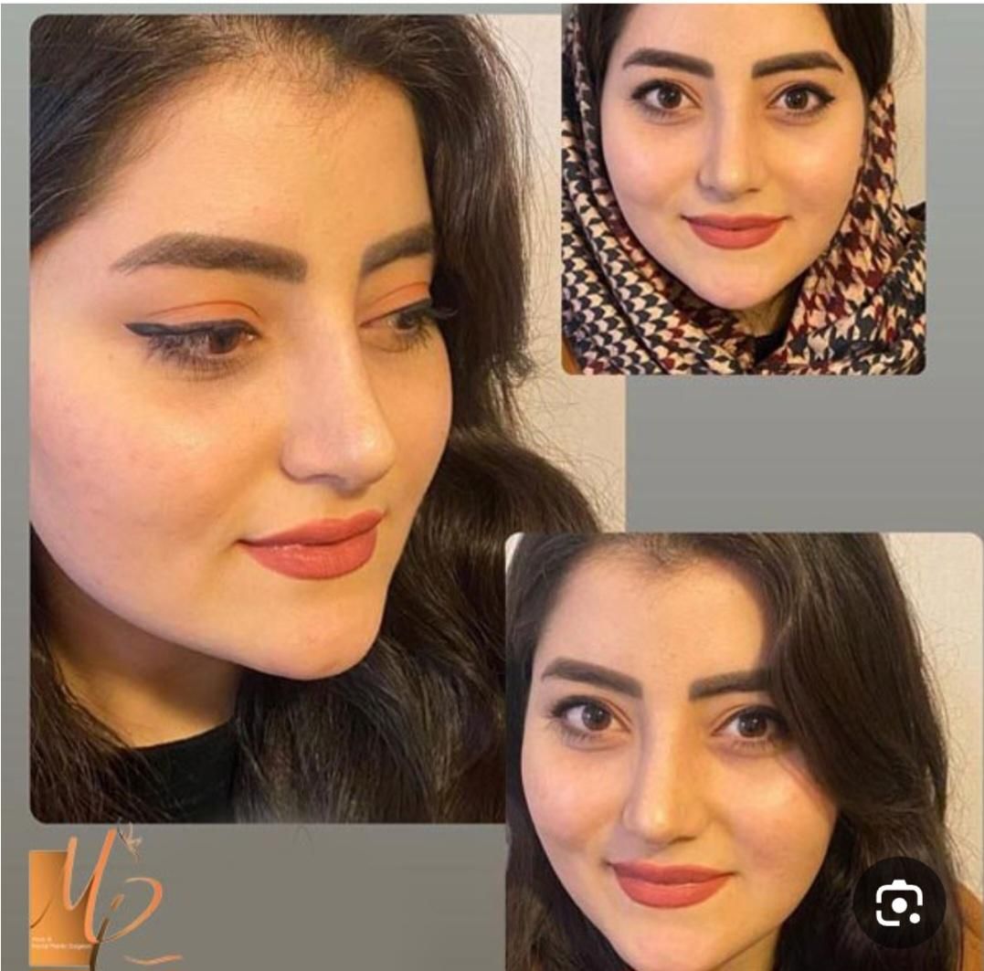 جشنواره تخفیفات تابستانه جراحی بینی،صورت،پیکرتراشی|خدمات آرایشگری و زیبایی|کرج, مهرویلا جنوبی|دیوار