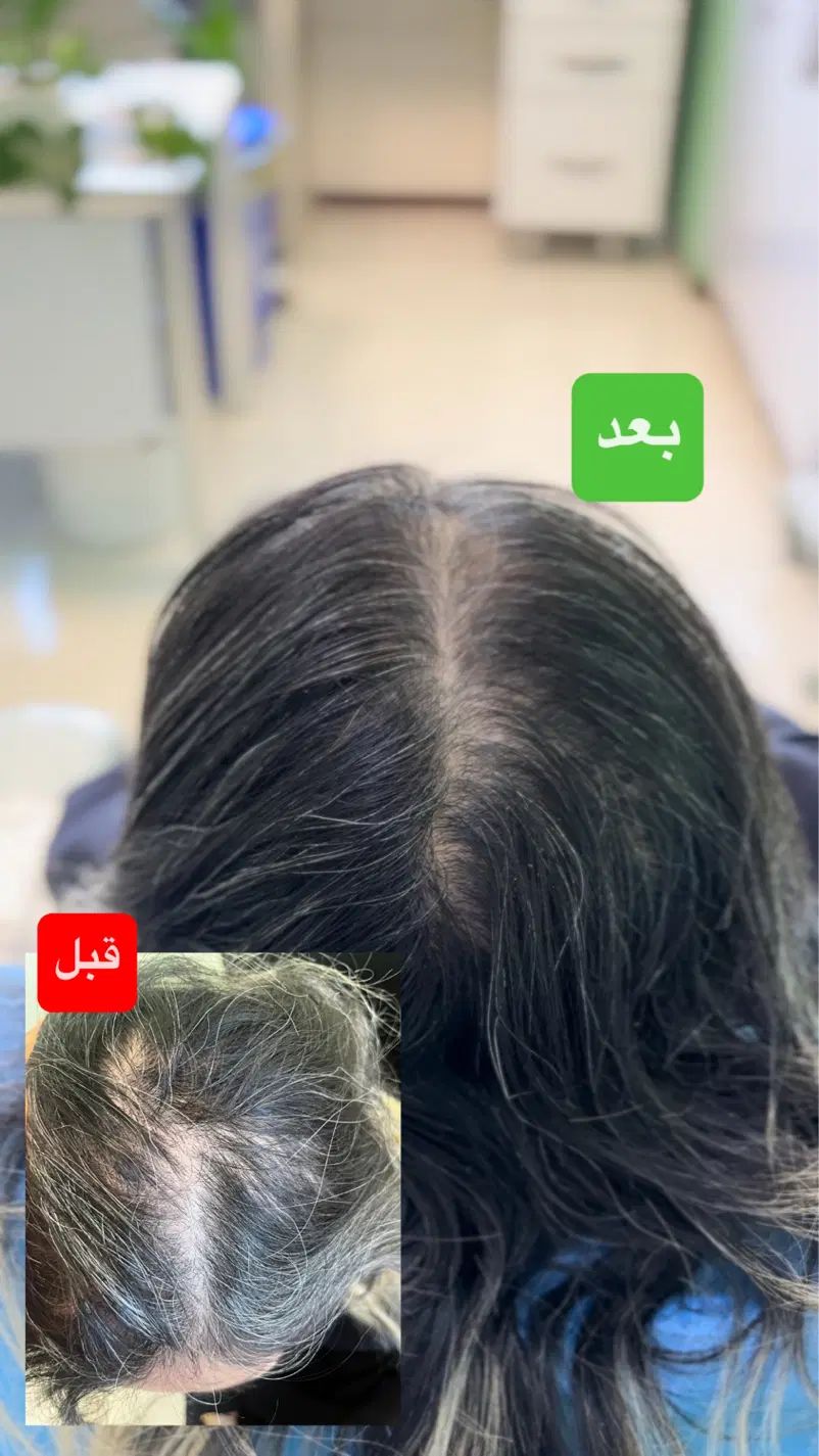 پی آر پی مو و صورت تخفیف ویژه پی ارپی بعدازکاشت مو|خدمات آرایشگری و زیبایی|قزوین, |دیوار