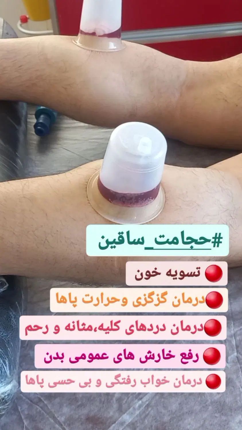 روغن ماساژ،درمان سیاتیک، دیسک، قلنج ،طب سوزنی|خدمات آرایشگری و زیبایی|تبریز, |دیوار