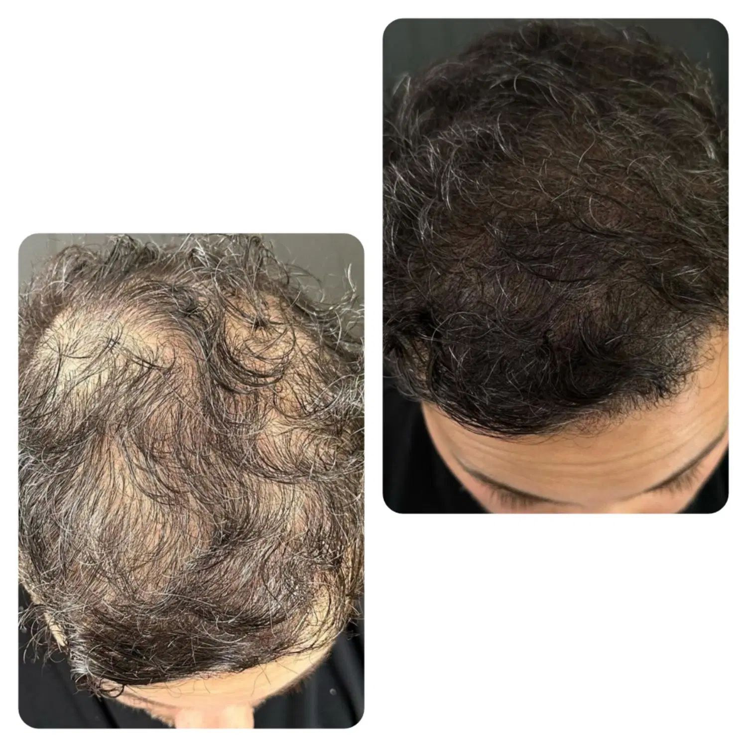آموزش و خدمات میکرواسکالپ ،اسکراب ،مکمل کاشت مو|خدمات آرایشگری و زیبایی|مشهد, صیاد شیرازی|دیوار