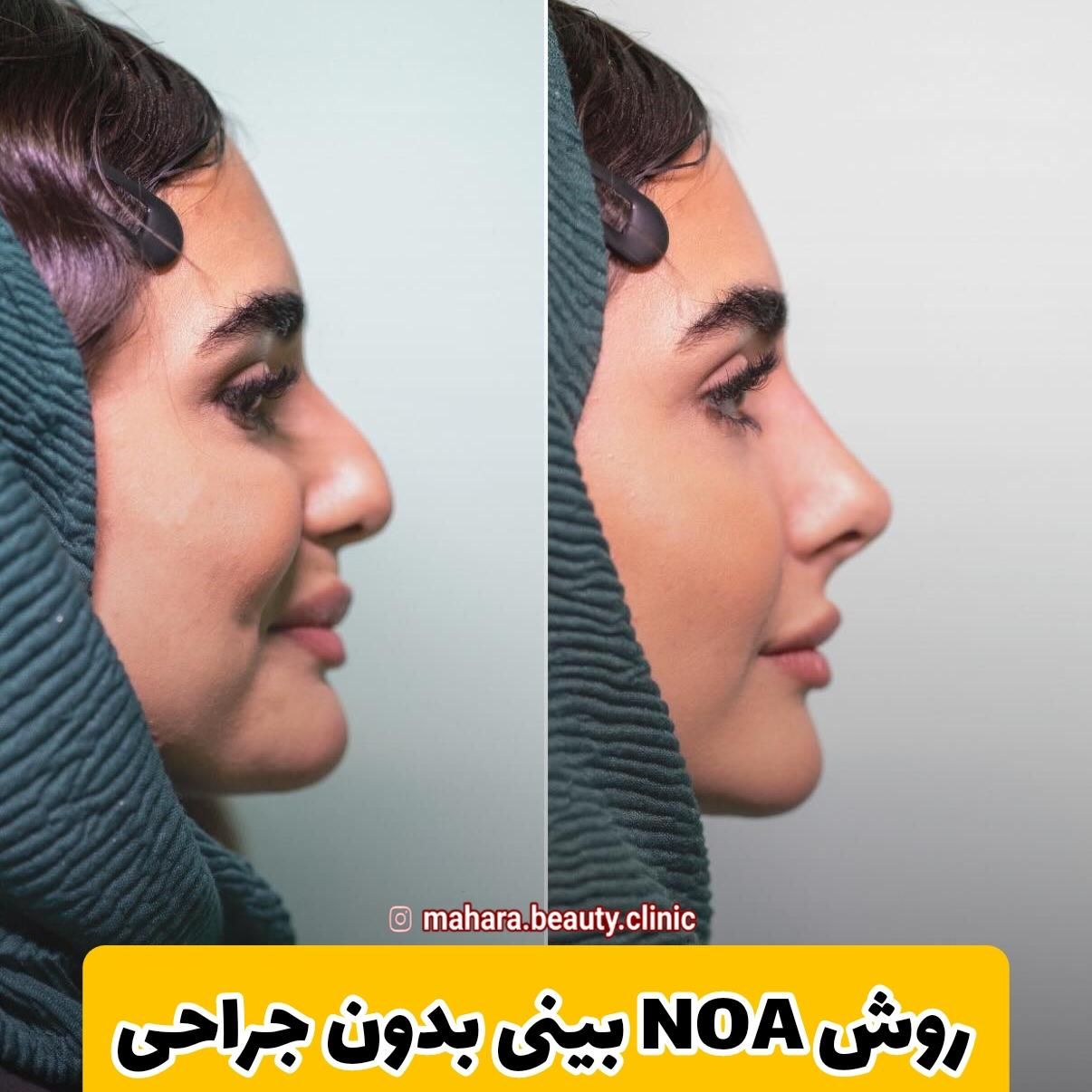 فرمدهی صورت بینی بدون جراحی بیهوشی پکیج یانگ فیس|خدمات آرایشگری و زیبایی|مشهد, هفت تیر (حافظ)|دیوار