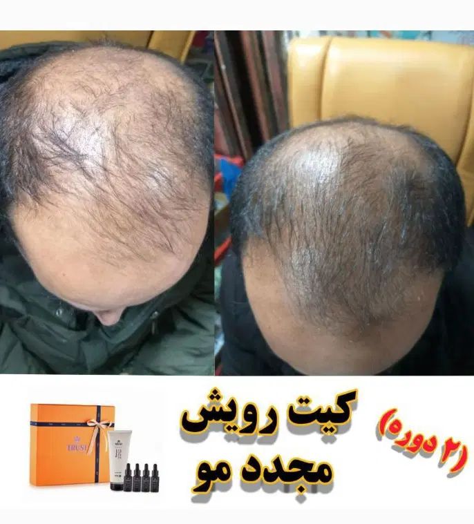درمان قطعی و تضمینی ریزش شدید مو ( مقطعی و سکه ای)|آرایشی، بهداشتی، درمانی|رشت, حاجی آباد|دیوار