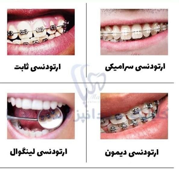 ارتودنسی کوتاه مدت|خدمات آرایشگری و زیبایی|شیراز, معالی‌آباد|دیوار