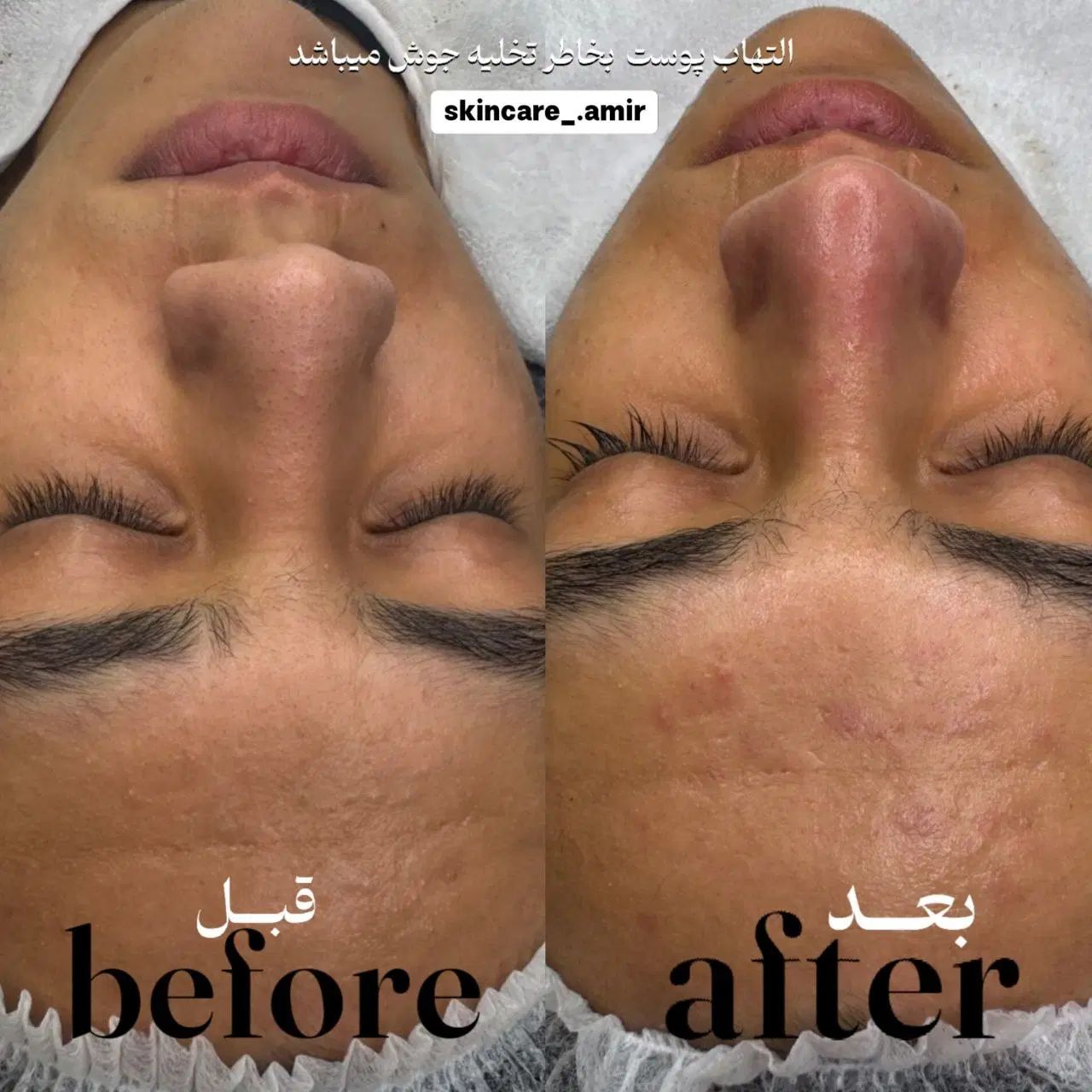فشیال تخصصی آقایان « پاکسازی پوست » فیشیال فیشال|خدمات آرایشگری و زیبایی|مشهد, الهیه|دیوار