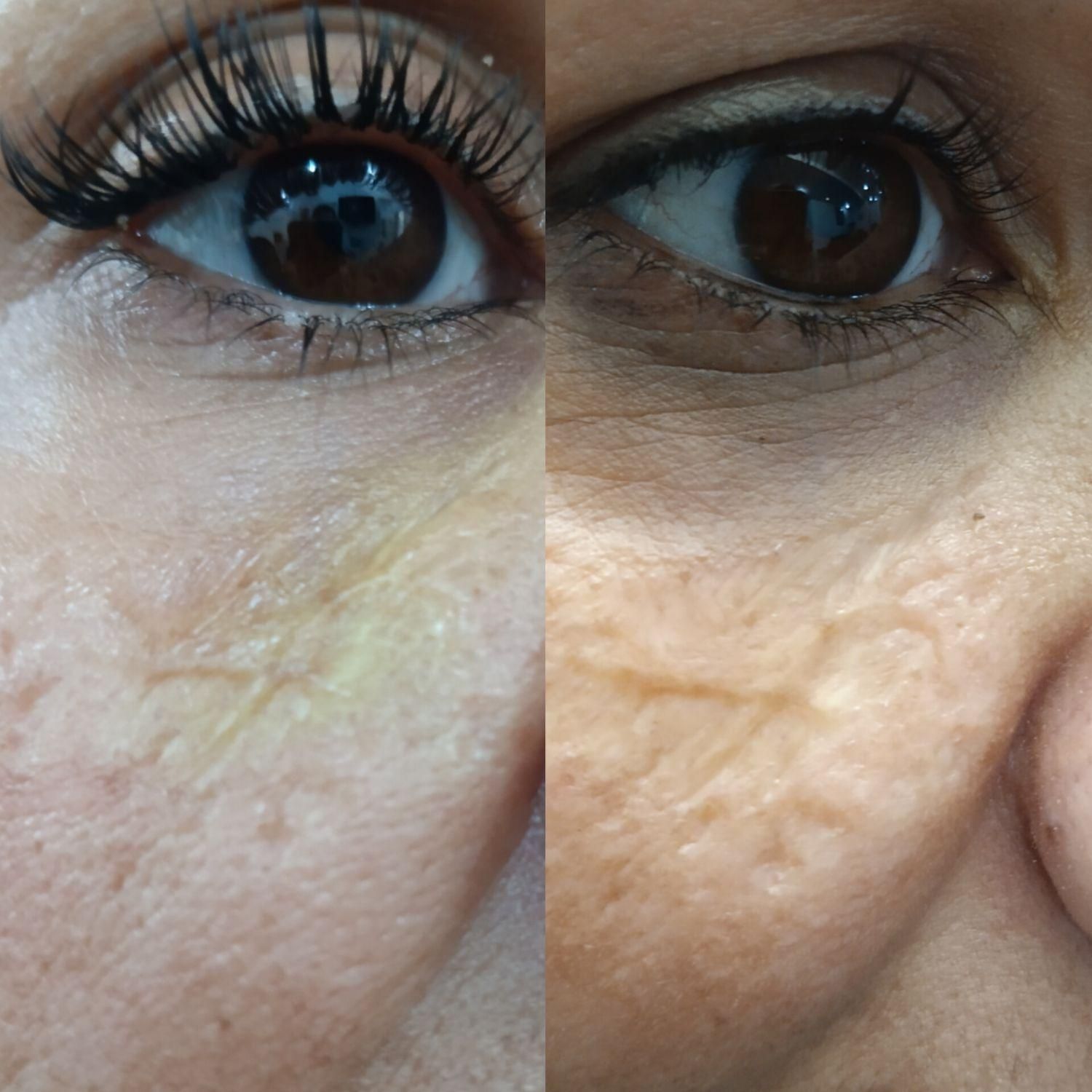 برداشتن انواع خال.جراحی غدد.جای سالک.زخم.سوختگی|خدمات آرایشگری و زیبایی|مشهد, هنرستان|دیوار