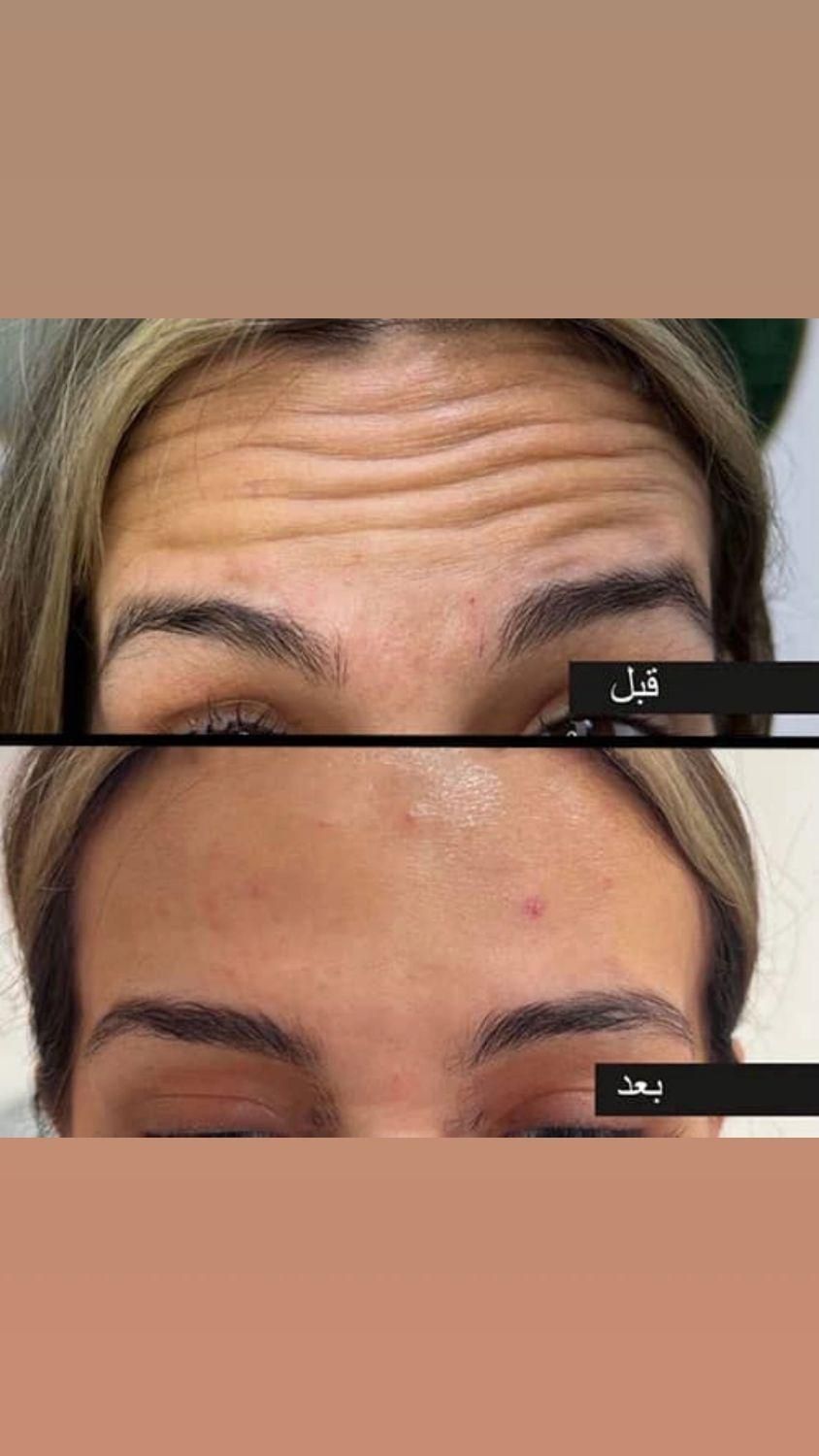 بوتاکس فقط ۹۵۰ ( پیشانی لبخند لثه ای زیر بغل و..)|خدمات آرایشگری و زیبایی|محمدیه-قزوین, |دیوار