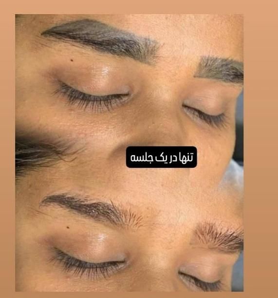 لیزر لک و لیزر کربن تراپی لاغری با کویتیشن و اراف|خدمات آرایشگری و زیبایی|فولادشهر, B4|دیوار