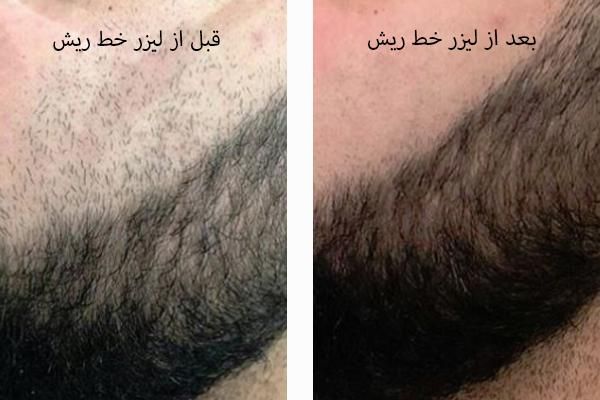 لیزر موهای زائد با قیمت ویژه برای اقایان|خدمات آرایشگری و زیبایی|خرم‌آباد, |دیوار