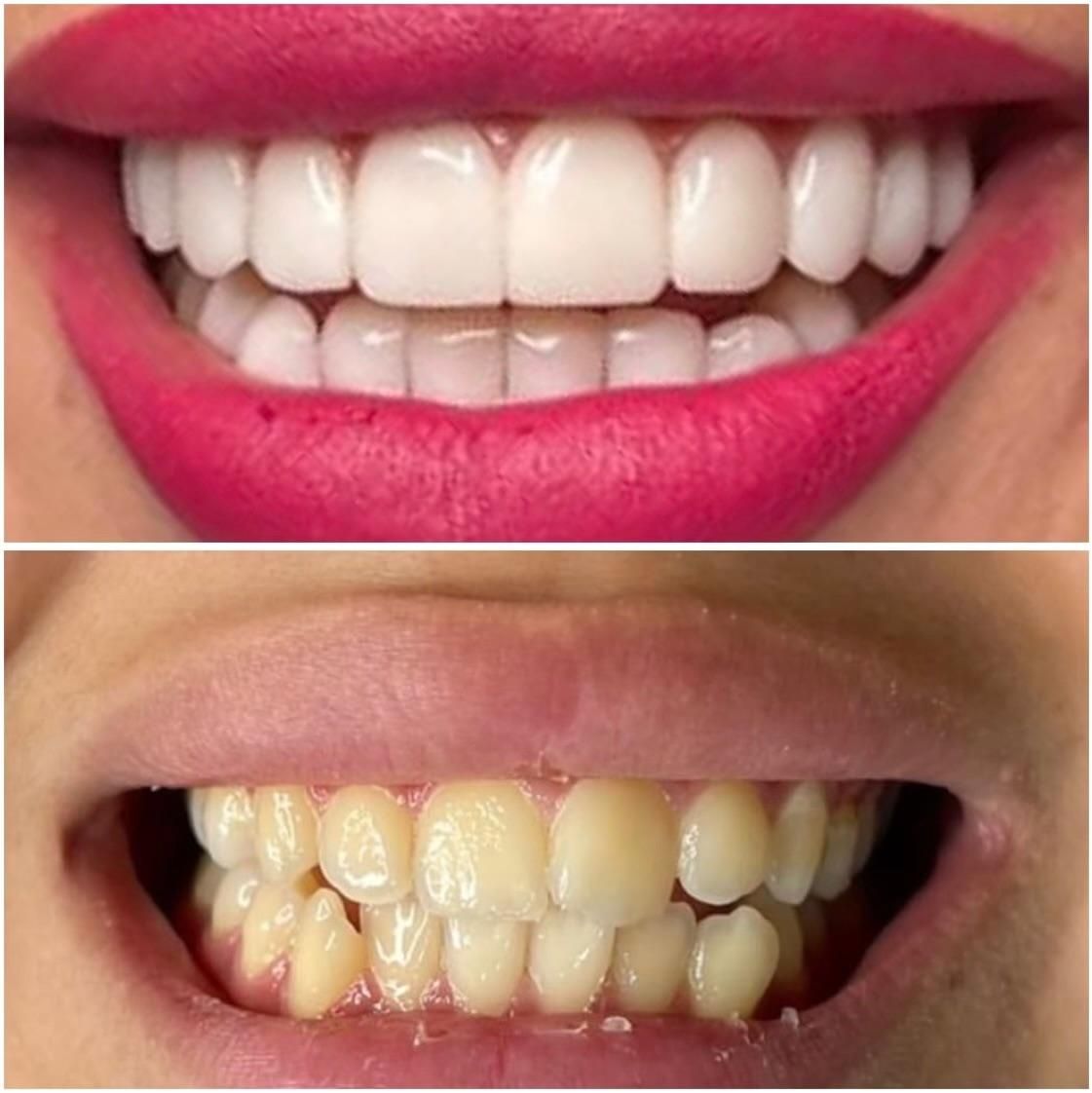 کامپوزیت بدون تراش  باقیمت استثنایی|خدمات آرایشگری و زیبایی|آمل, |دیوار