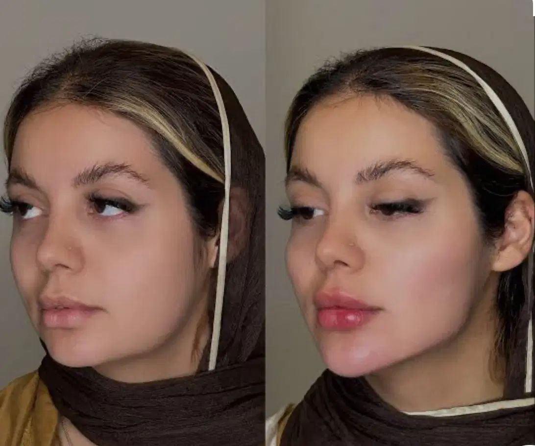 تزریق ژل فیلر/بوتاکس/prp پوست مو/پی آر پی/مزوتراپی|خدمات آرایشگری و زیبایی|کرج, گوهردشت|دیوار