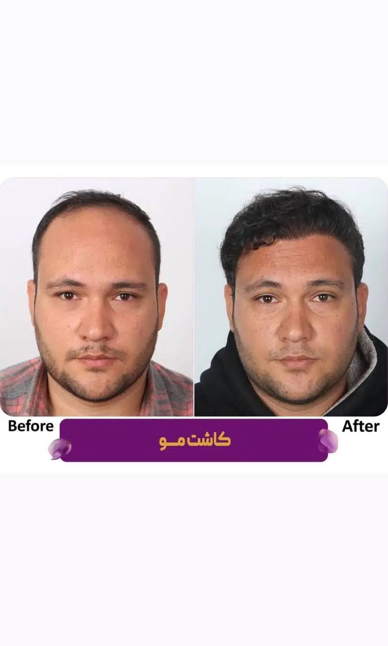 کاشت مو و کاشت ابرو با تراکم بالا بدون درد|خدمات آرایشگری و زیبایی|مشهد, احمدآباد|دیوار