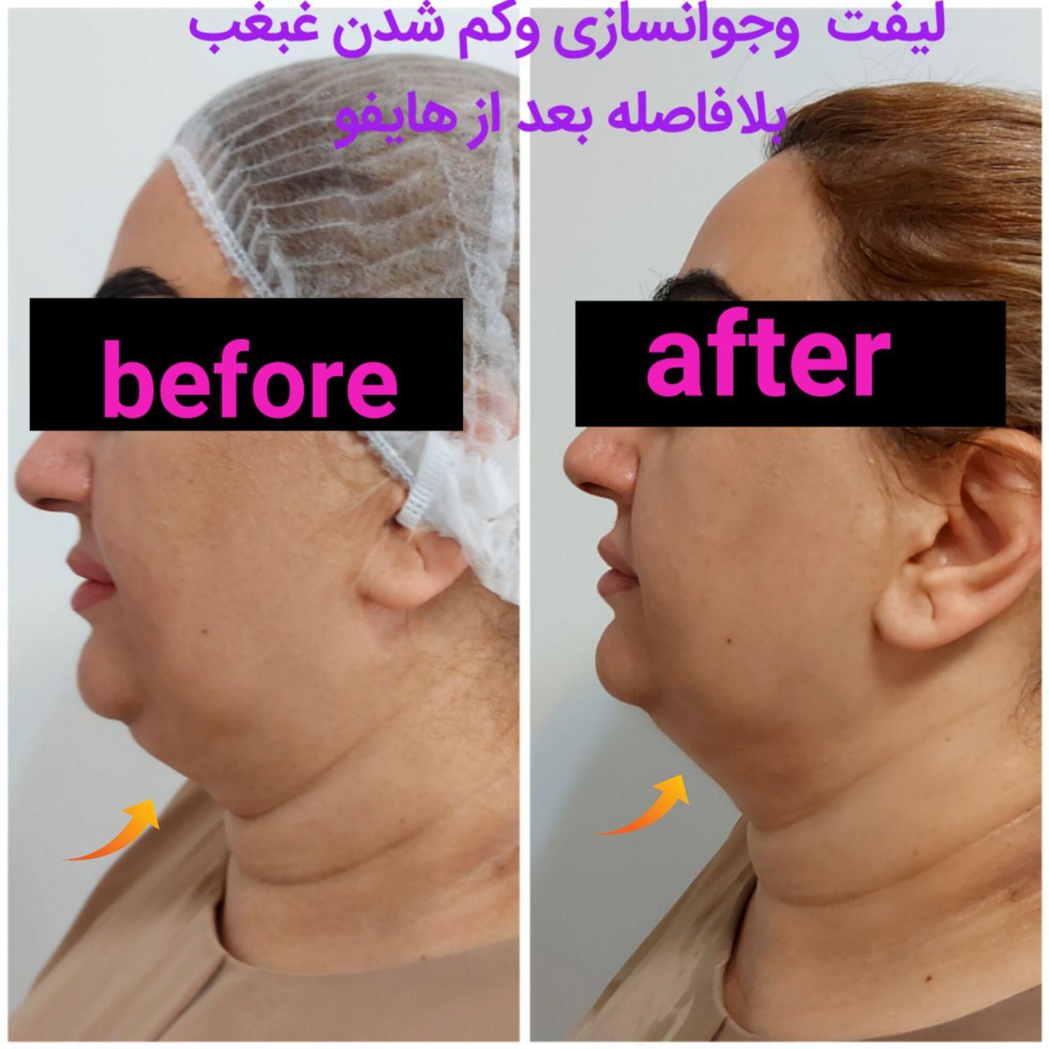 هایفوتراپی،لیفت وجوانسازی صورت،رفع غبغب|خدمات آرایشگری و زیبایی|تهران, ظفر|دیوار