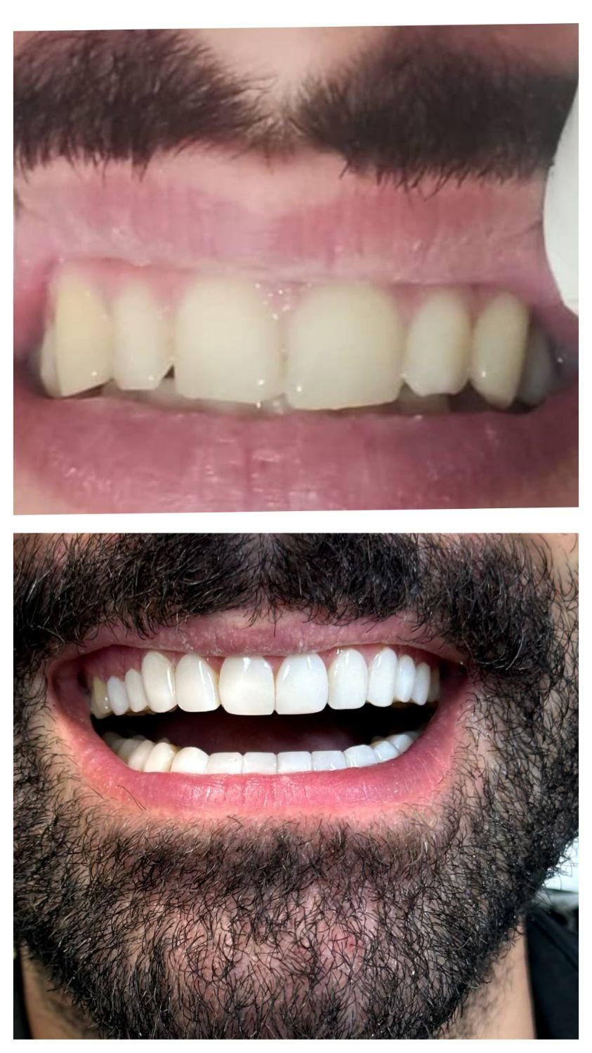 دندانپزشکی شاین . ترمیم دندان . کامپوزیت|خدمات آرایشگری و زیبایی|بابل, |دیوار