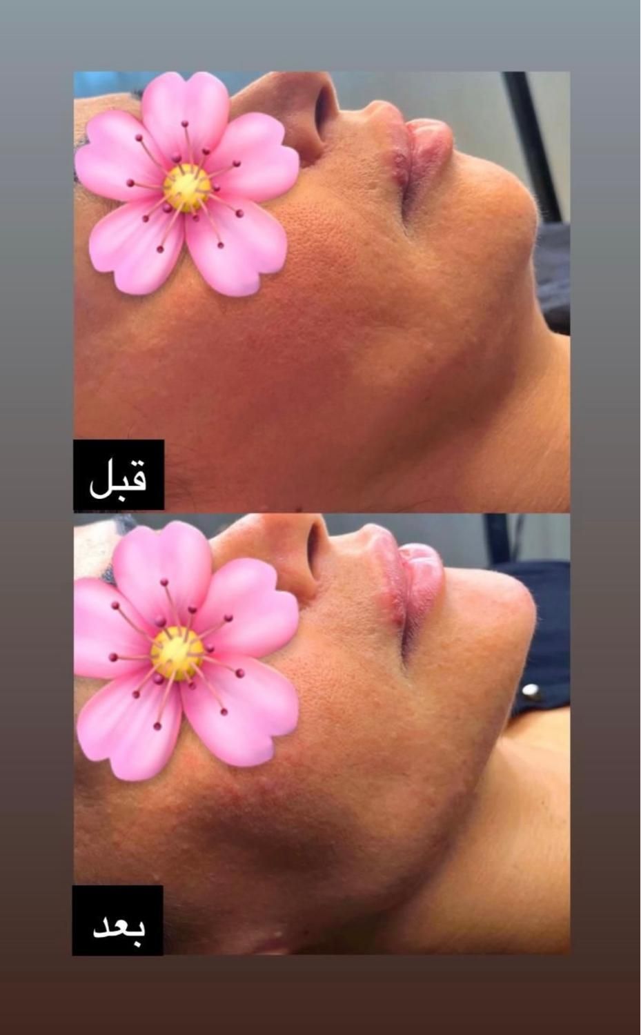 تخفیفات خدمات فیلر و بوتاکس کلینیک|خدمات آرایشگری و زیبایی|شاهین‌شهر, فردوسی|دیوار