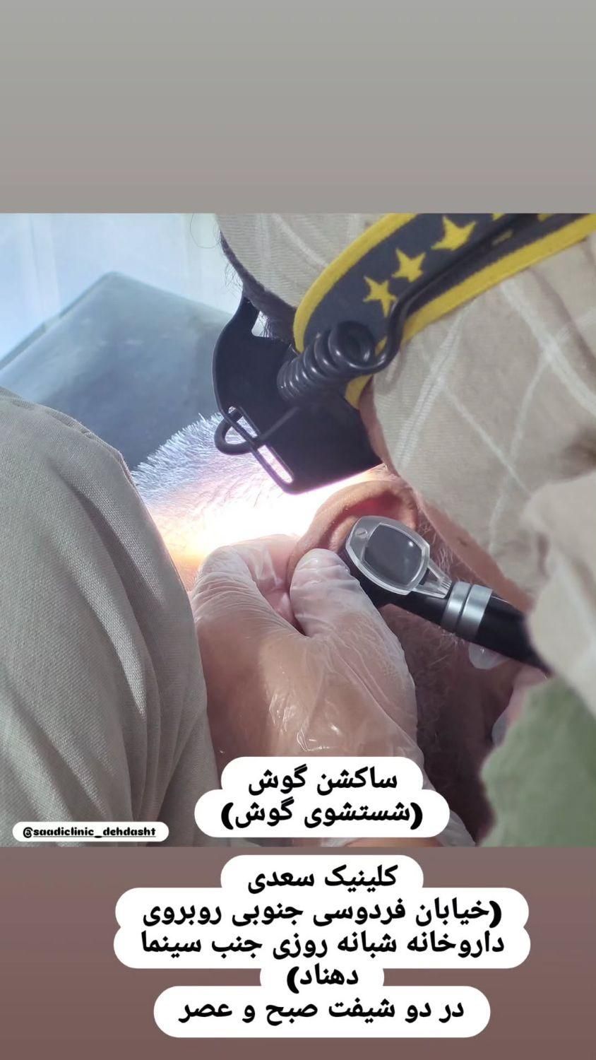 ساکشن گوش-شستشوی گوش|خدمات آرایشگری و زیبایی|دهدشت, |دیوار