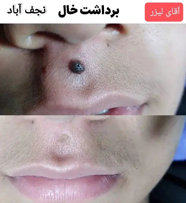 خال صورت/لکه های پوستی/لیزرموسفید/ریموتتو/بوتاکس|خدمات آرایشگری و زیبایی|نجف‌آباد, بازار|دیوار