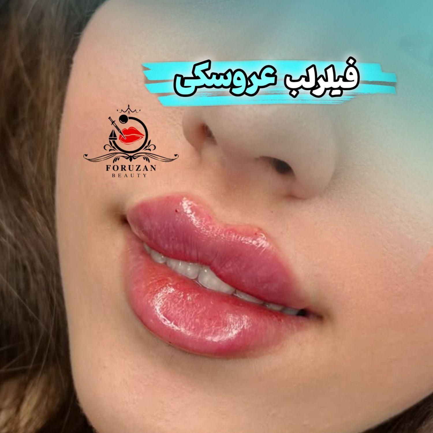 آفر(۷ روزه) ژل و بوتاکس فولادشهر|خدمات آرایشگری و زیبایی|فولادشهر, فولادشهر|دیوار
