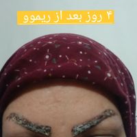 ریموو تَتوی صورت تنها در یک جلسه و بدون درد|خدمات آرایشگری و زیبایی|تهران, قیطریه|دیوار