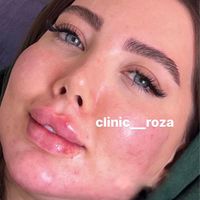 مدل تزریق ژل فیلر کانتورینگ عربی لب روسی|خدمات آرایشگری و زیبایی|کرج, گوهردشت|دیوار
