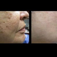 جشنواره تخصصی پی ار پی prp|خدمات آرایشگری و زیبایی|اصفهان, میرعماد|دیوار