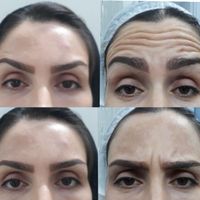 بوتاکس/ژل گونه چانه زاویه/مادلینگ/لیفت نخ/مزوژل|خدمات آرایشگری و زیبایی|تهران, فدک|دیوار