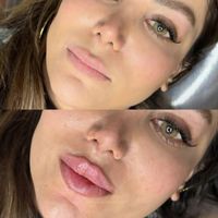 کلینیک تزریق ژل بوتاکس فیلر زیرچشم هایفولیزر انزیم|خدمات آرایشگری و زیبایی|کرج, گوهردشت|دیوار