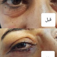 رفع چروک زیر چشم/رفع پف زیر چشم|خدمات آرایشگری و زیبایی|اصفهان, خلجا|دیوار