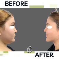جراحی رفع غبغب لیپوساکشن اندولیفت و بوکال فت|خدمات آرایشگری و زیبایی|تهران, شهرک غرب|دیوار