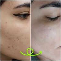 لیزرموهای زائد،ژل وبوتاکس،پی آرپی و کربوکسی .دالیا|خدمات آرایشگری و زیبایی|تهران, پیروزی|دیوار