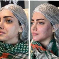 جشنواره  تزریق چربی لیزر لاغری ژل بوتاکس|خدمات آرایشگری و زیبایی|تهران, هفت حوض|دیوار