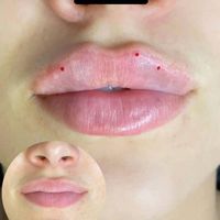 جشنواره تزریق ژل فیلر و بوتاکس و پی آر پی ( PRP )|خدمات آرایشگری و زیبایی|تهران, جنت‌آباد جنوبی|دیوار