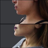 لیزر co2/لیزر موی زائد/لیپوماتیک/هایفو/فیلر|خدمات آرایشگری و زیبایی|تهران, سعادت‌آباد|دیوار