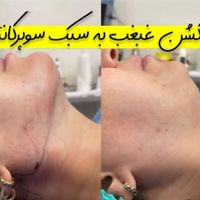 جشنواره یلدایی لیزرموهای زائد ژل وبوتاکس|خدمات آرایشگری و زیبایی|تهران, تهرانپارس شرقی|دیوار