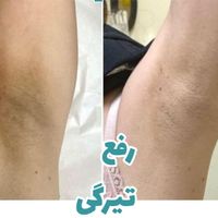 ریموو تاتو خالکوبی بدن و وایتنینگ بالیزر توسط پزشک|خدمات آرایشگری و زیبایی|تهران, شهرک غرب|دیوار