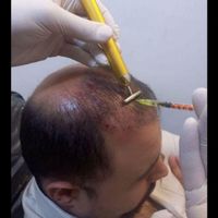 ژل بوتاکس لیزر مزو پی آر پی خالیرداری جوانسازی|خدمات آرایشگری و زیبایی|تهران, افسریه|دیوار